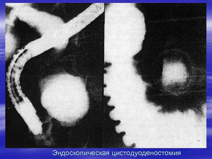 Эндоскопическая цистодуоденостомия 