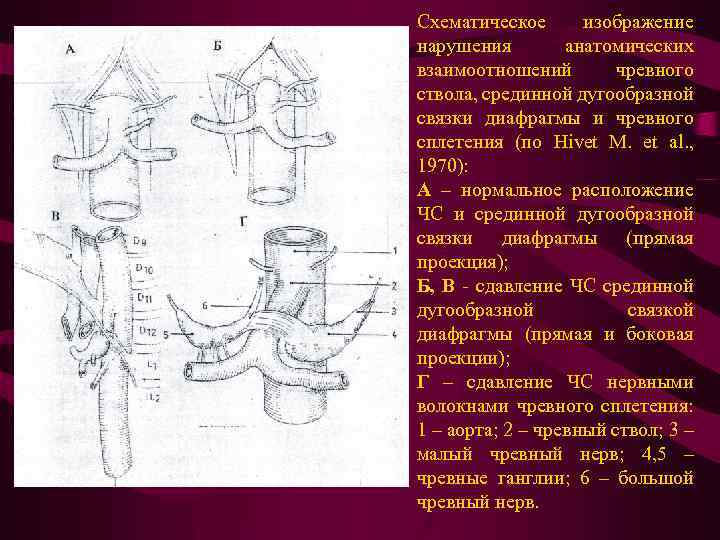 Схематическое изображение нарушения анатомических взаимоотношений чревного ствола, срединной дугообразной связки диафрагмы и чревного сплетения