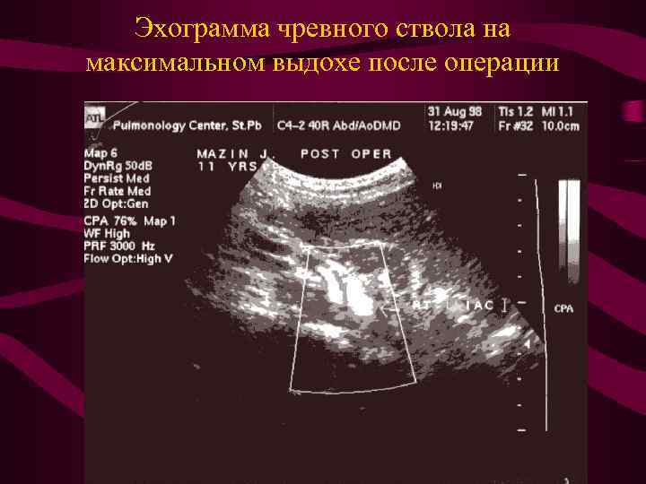 Эхограмма чревного ствола на максимальном выдохе после операции 