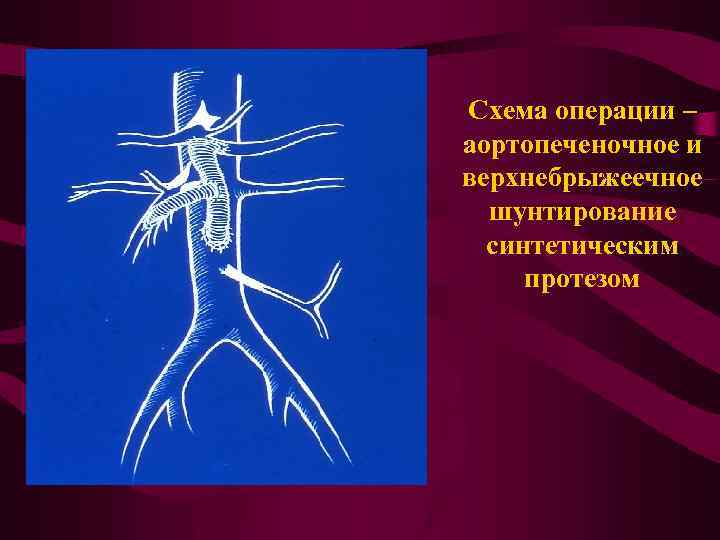 Схема операции – аортопеченочное и верхнебрыжеечное шунтирование синтетическим протезом 