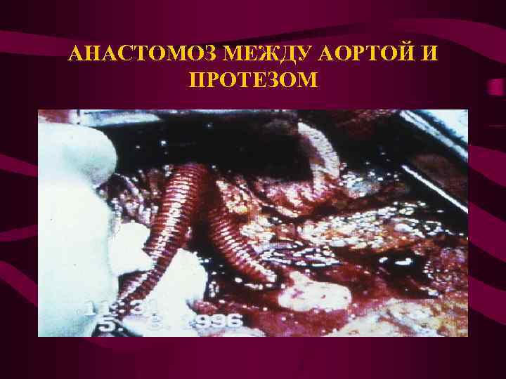АНАСТОМОЗ МЕЖДУ АОРТОЙ И ПРОТЕЗОМ 
