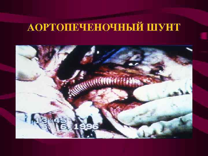 АОРТОПЕЧЕНОЧНЫЙ ШУНТ 
