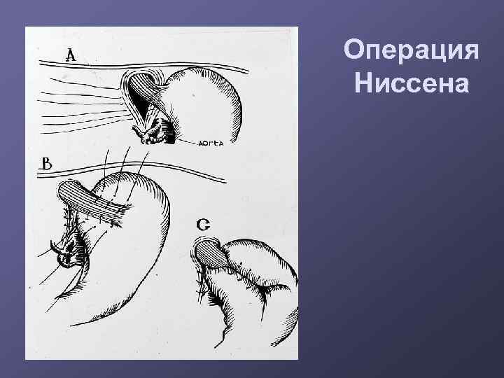 Операция Ниссена 