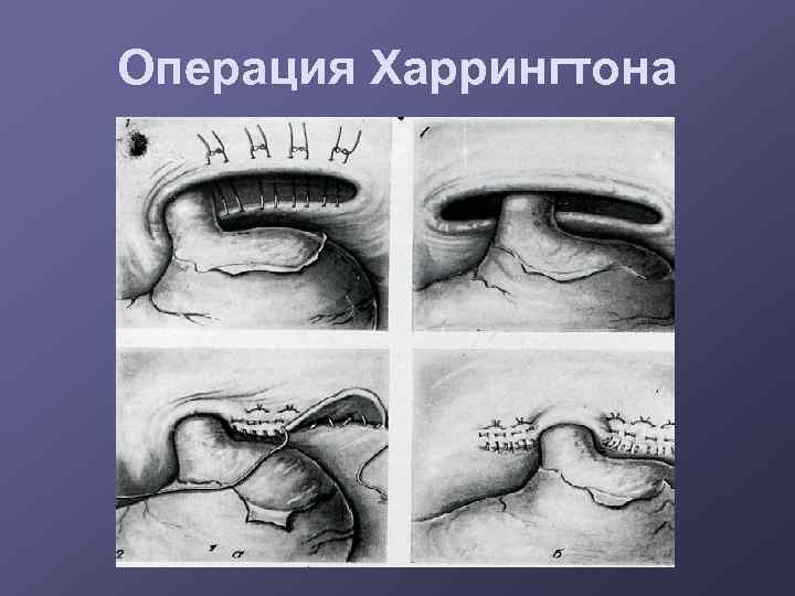 Операция Харрингтона 