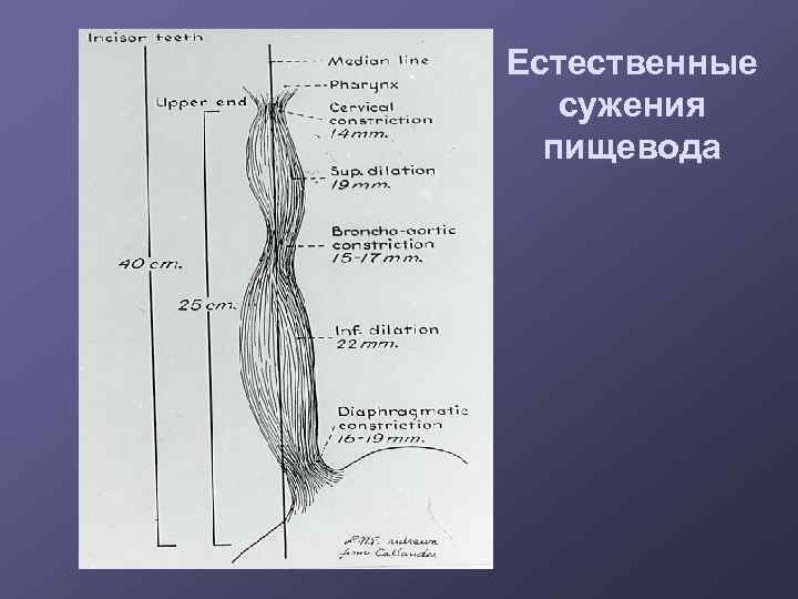 Естественные сужения пищевода 