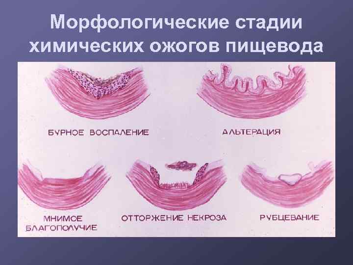 Морфологические стадии химических ожогов пищевода 