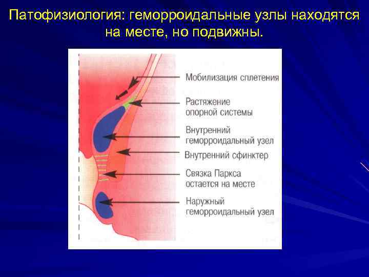 Патофизиология: геморроидальные узлы находятся на месте, но подвижны. 