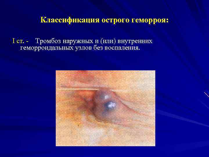Классификация острого геморроя: I ст. - Тромбоз наружных и (или) внутренних геморроидальных узлов без