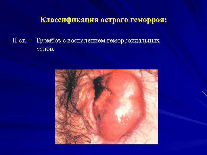 Классификация острого геморроя: II ст. - Тромбоз с воспалением геморроидальных узлов. 