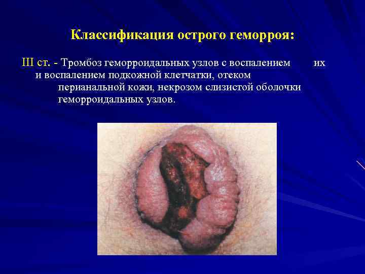 Классификация острого геморроя: III ст. - Тромбоз геморроидальных узлов с воспалением и воспалением подкожной