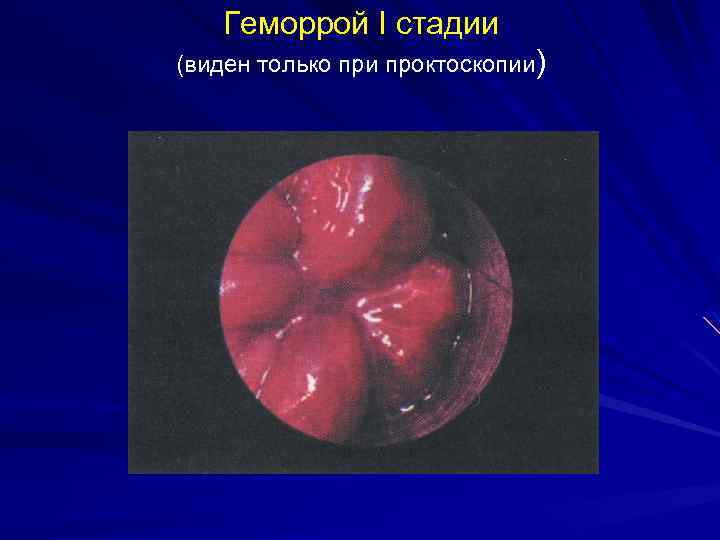 Геморрой I стадии (виден только при проктоскопии) 