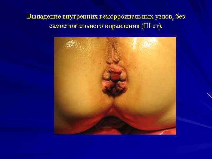 Выпадение внутренних геморроидальных узлов, без самостоятельного вправления (III ст). 