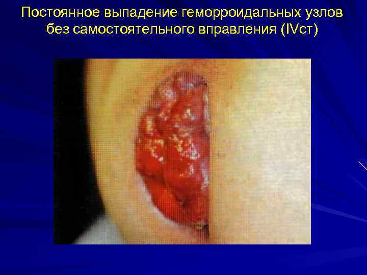 Постоянное выпадение геморроидальных узлов без самостоятельного вправления (IVст) 