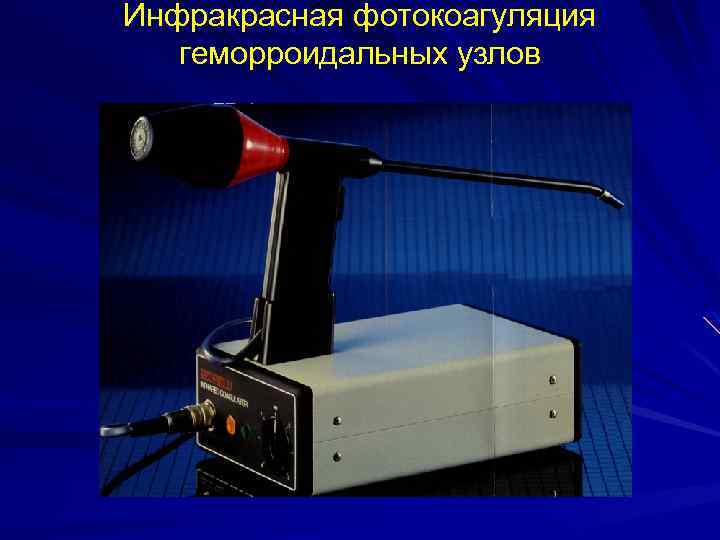 Инфракрасная фотокоагуляция геморроидальных узлов 