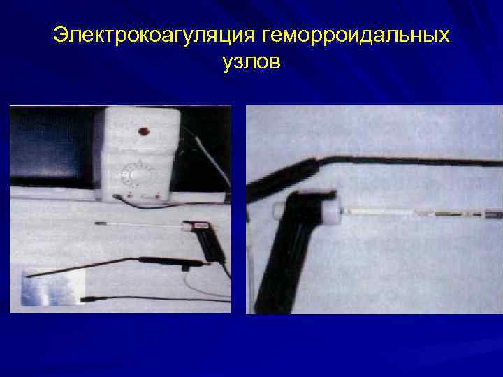 Электрокоагуляция геморроидальных узлов 
