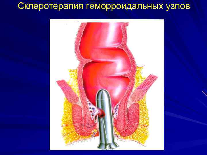 Склеротерапия геморроидальных узлов 