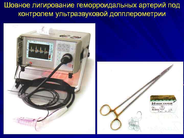 Шовное лигирование геморроидальных артерий под контролем ультразвуковой допплерометрии 