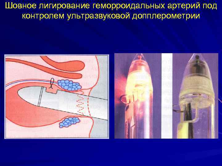 Шовное лигирование геморроидальных артерий под контролем ультразвуковой допплерометрии 