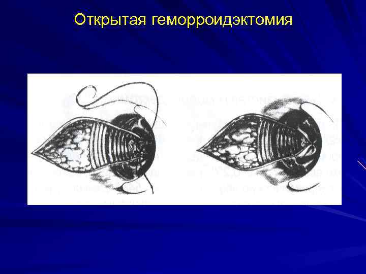 Открытая геморроидэктомия 