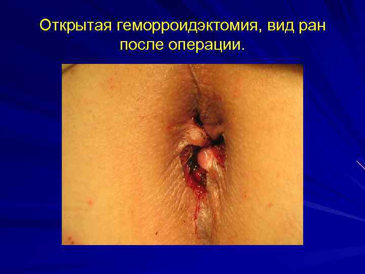 Открытая геморроидэктомия, вид ран после операции. 
