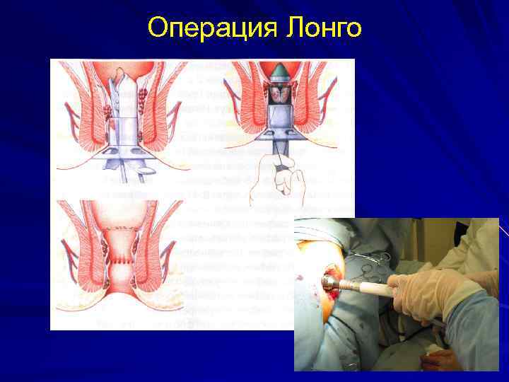 Операция Лонго 