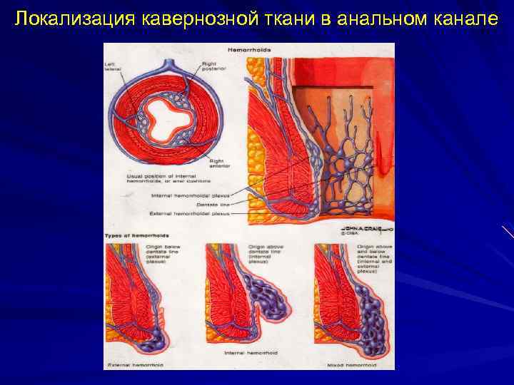 Локализация кавернозной ткани в анальном канале 