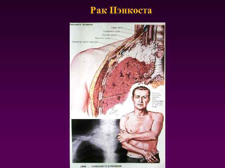 Рак Пэнкоста 