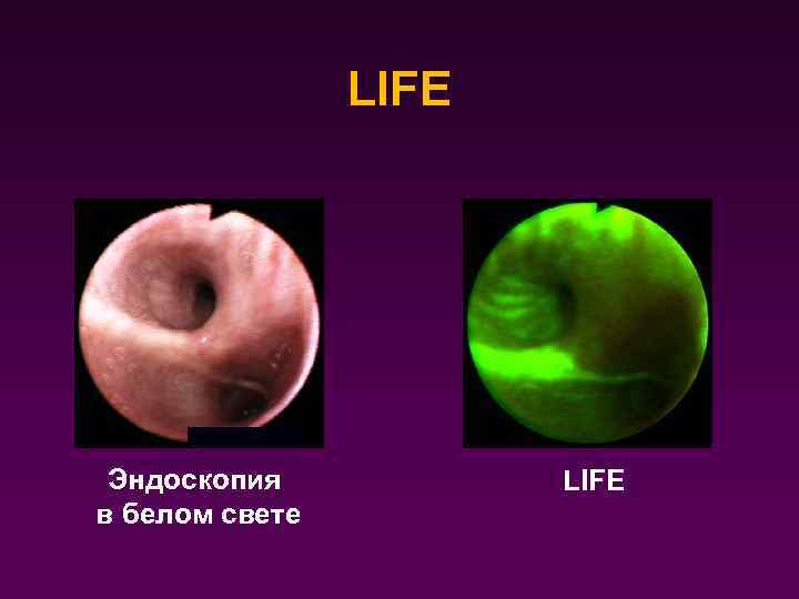 LIFE Эндоскопия в белом свете LIFE 
