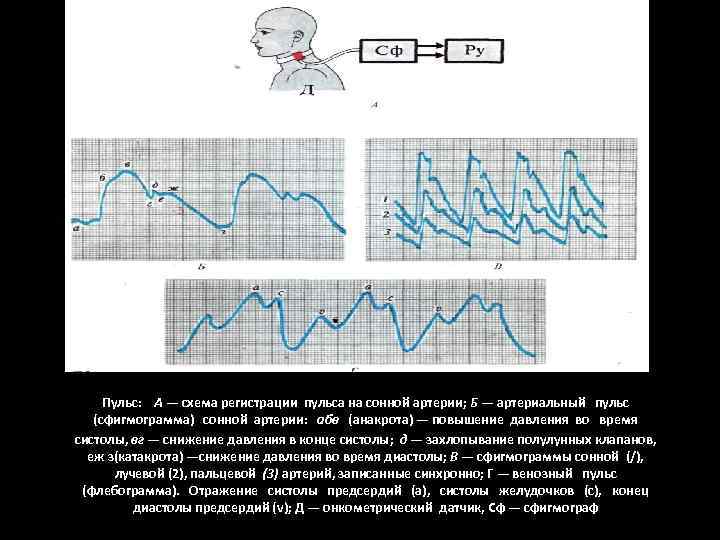 Пульс: А — схема регистрации пульса на сонной артерии; Б — артериальный пульс (сфигмограмма)