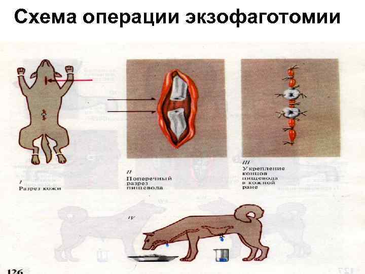 Схема операции экзофаготомии 