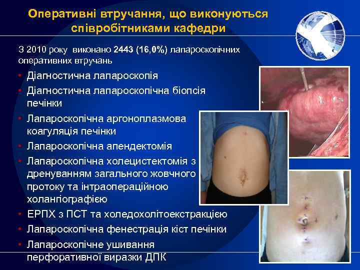 Оперативні втручання, що виконуються співробітниками кафедри З 2010 року виконано 2443 (16, 0%) лапароскопічних