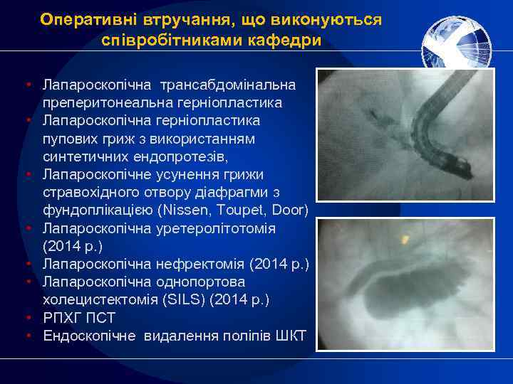 Оперативні втручання, що виконуються співробітниками кафедри • Лапароскопічна трансабдомінальна преперитонеальна герніопластика • Лапароскопічна герніопластика