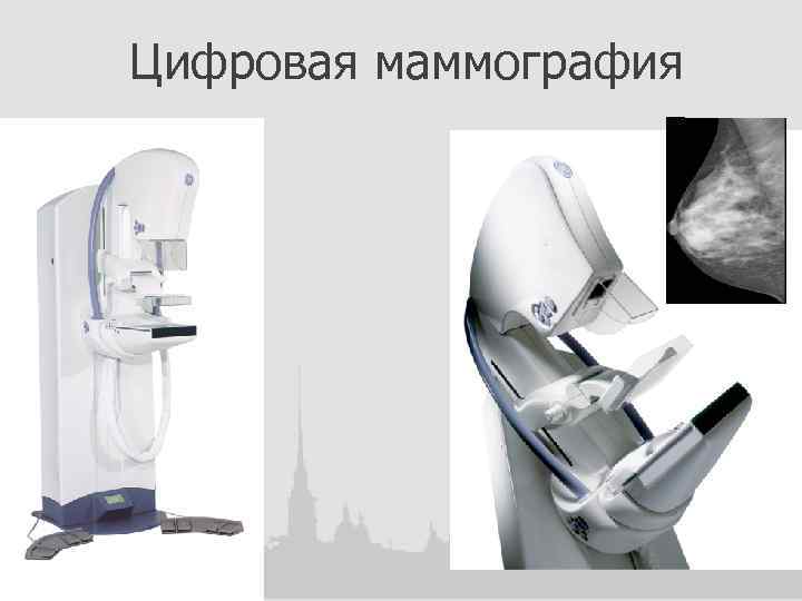 Цифровая маммография 
