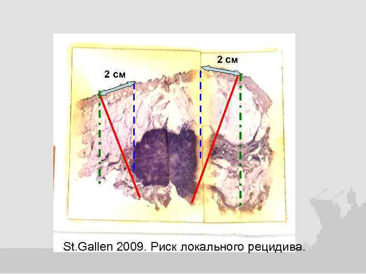 2 см St. Gallen 2009. Риск локального рецидива. 