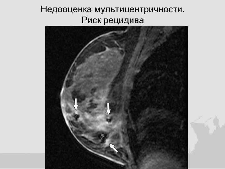 Недооценка мультицентричности. Риск рецидива 