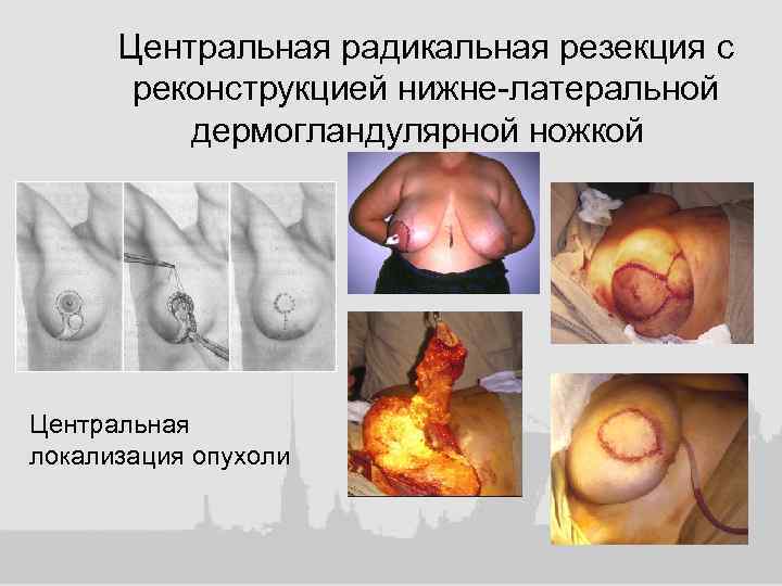 Центральная радикальная резекция с реконструкцией нижне-латеральной дермогландулярной ножкой Центральная локализация опухоли 