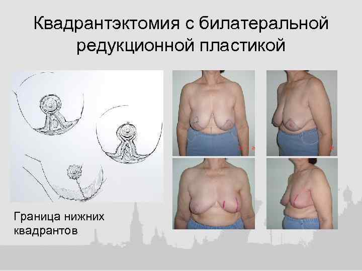Квадрантэктомия с билатеральной редукционной пластикой Граница нижних квадрантов 