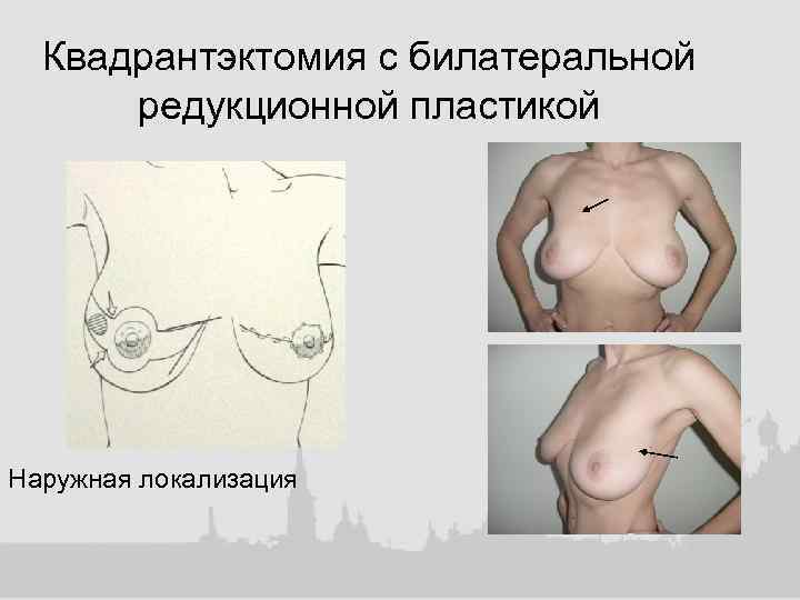 Квадрантэктомия с билатеральной редукционной пластикой Наружная локализация 