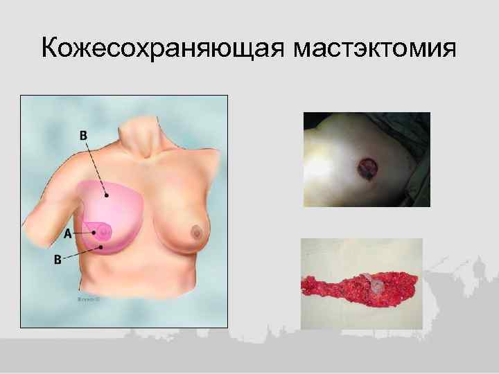 Кожесохраняющая мастэктомия 