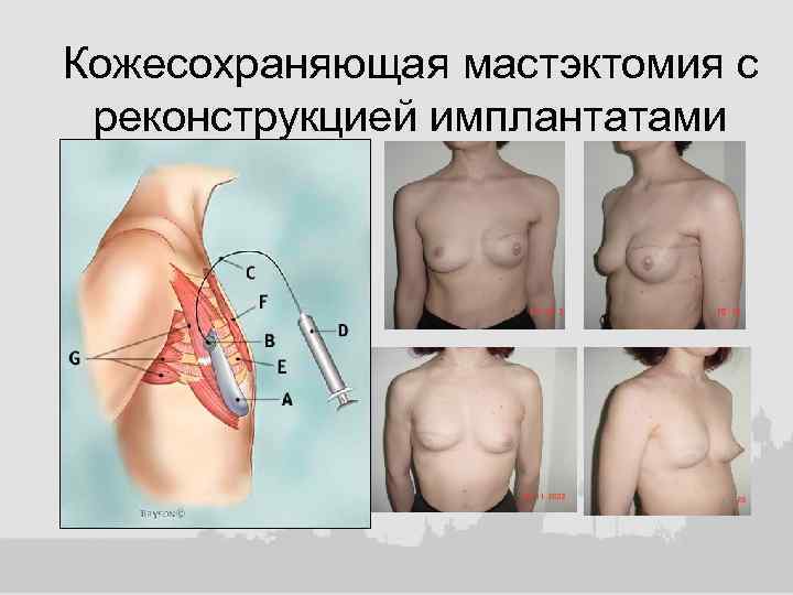 Кожесохраняющая мастэктомия с реконструкцией имплантатами 