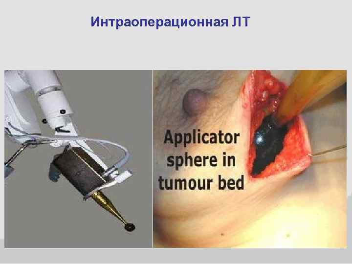 Интраоперационная ЛТ 