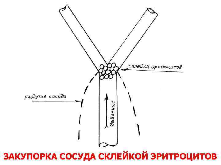 ЗАКУПОРКА СОСУДА СКЛЕЙКОЙ ЭРИТРОЦИТОВ 