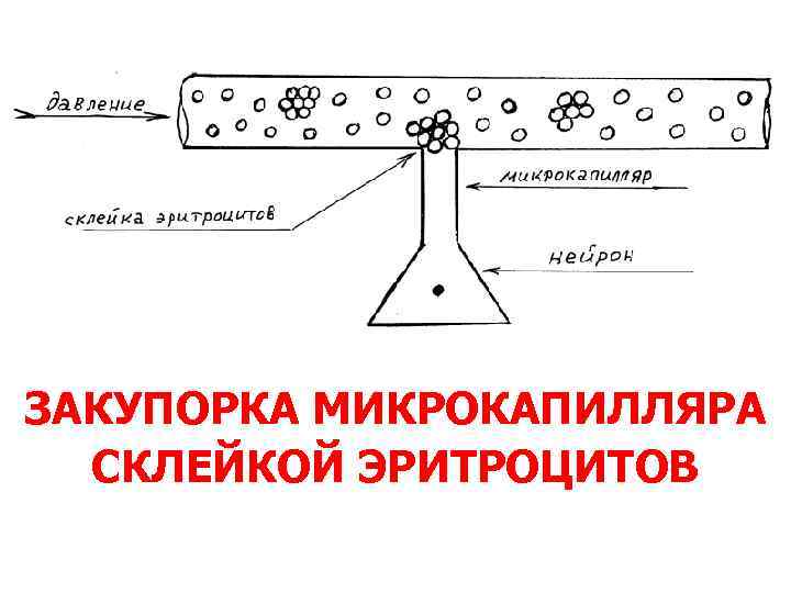 ЗАКУПОРКА МИКРОКАПИЛЛЯРА СКЛЕЙКОЙ ЭРИТРОЦИТОВ 