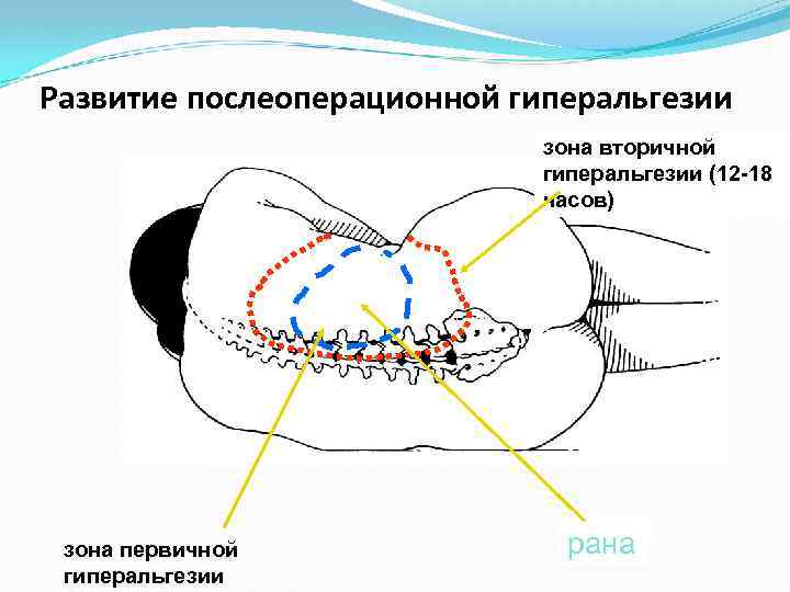 Развитие послеоперационной гиперальгезии зона вторичной гиперальгезии (12 -18 часов) зона первичной гиперальгезии рана 