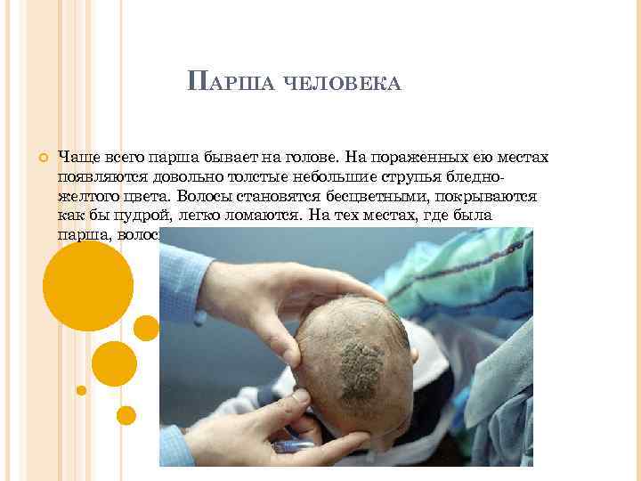 ПАРША ЧЕЛОВЕКА Чаще всего парша бывает на голове. На пораженных ею местах появляются довольно