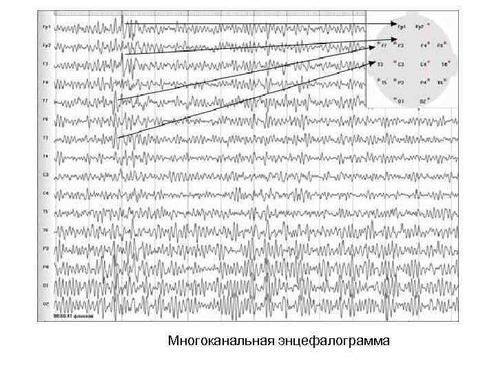 Многоканальная энцефалограмма 