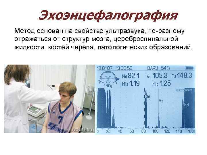  Эхоэнцефалография Метод основан на свойстве ультразвука, по-разному отражаться от структур мозга, цереброспинальной жидкости,