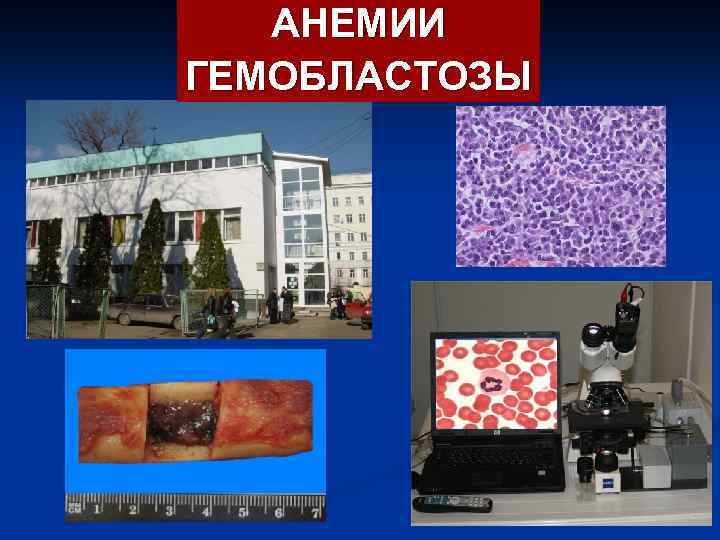 АНЕМИИ ГЕМОБЛАСТОЗЫ 