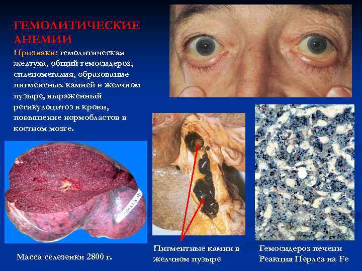 ГЕМОЛИТИЧЕСКИЕ АНЕМИИ Признаки: гемолитическая желтуха, общий гемосидероз, спленомегалия, образование пигментных камней в желчном пузыре,