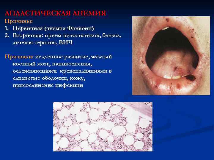 АПЛАСТИЧЕСКАЯ АНЕМИЯ Причины: 1. Первичная (анемия Фанкони) 2. Вторичная: прием цитостатиков, бензол, лучевая терапия,